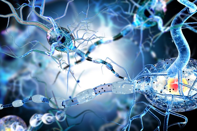 3D illustration of damaged neurons with disrupted myelin sheaths, representing neurodegeneration in conditions such as Alzheimer’s disease.
