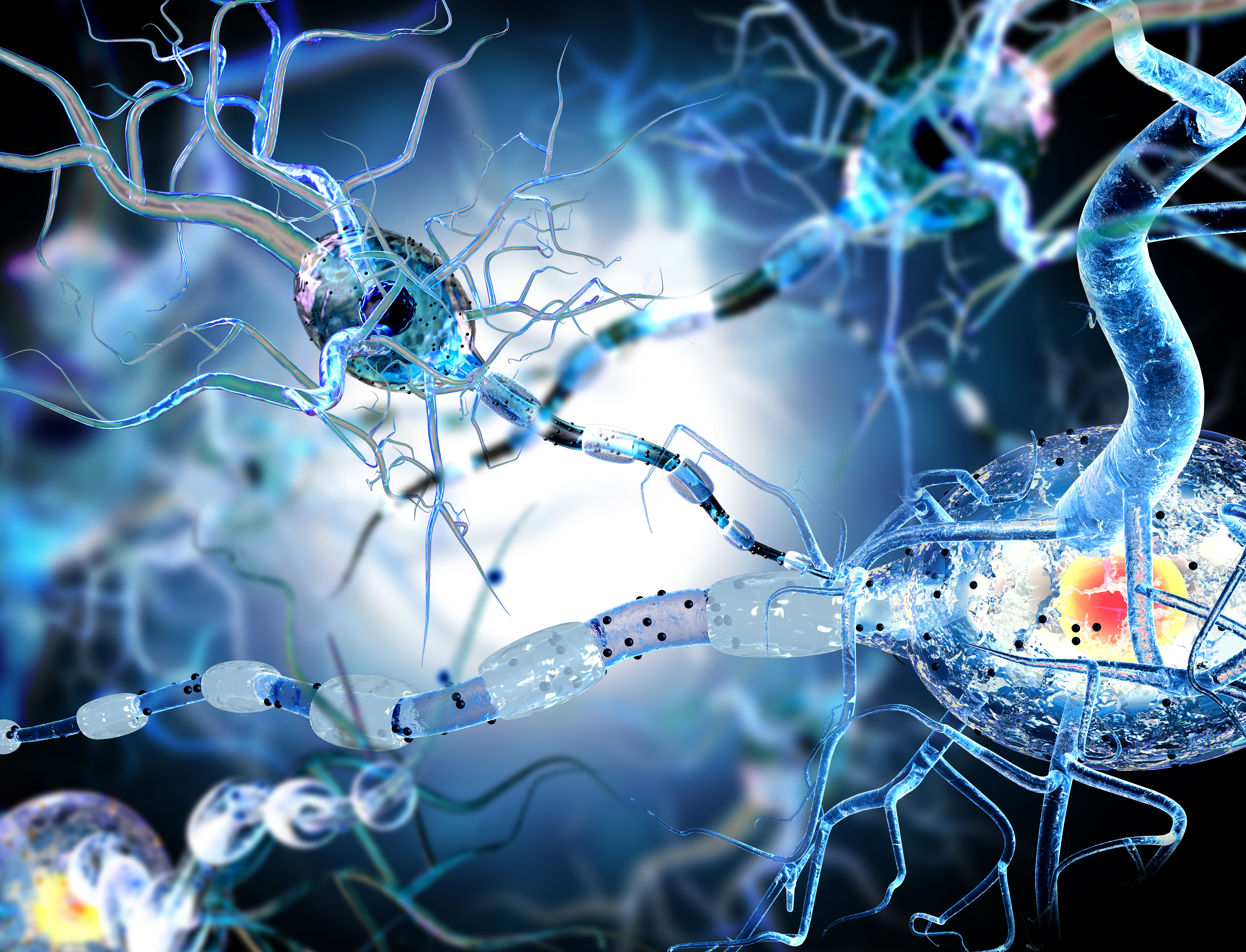 3D illustration of damaged neurons with disrupted myelin sheaths, representing neurodegeneration in conditions such as Alzheimer’s disease.
