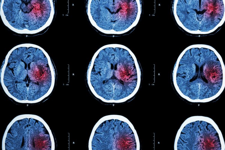 Brain scan with red areas, indicating stroke