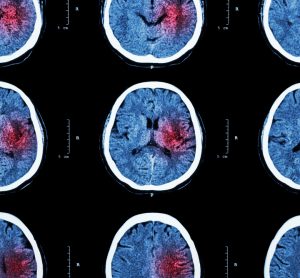 CT brain imaging for stroke