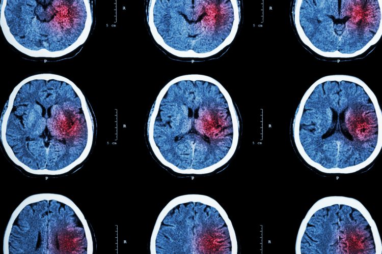 CT brain imaging for stroke