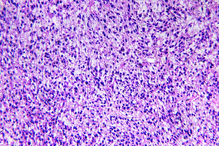 Microscopic view of habdomyosarcoma