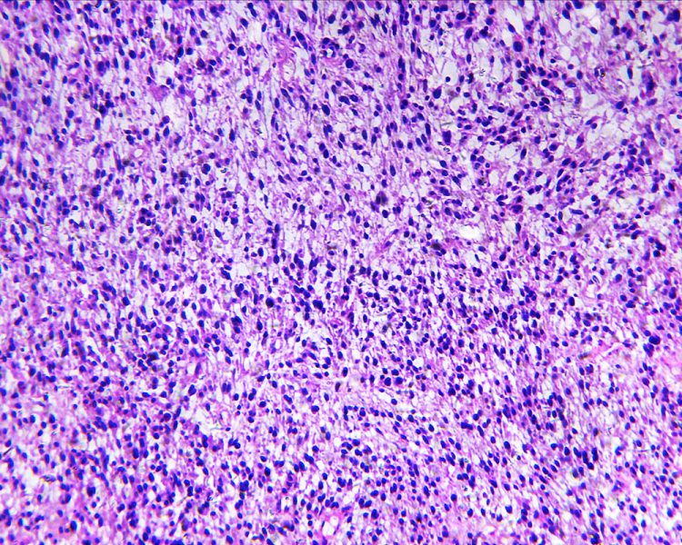 Microscopic view of habdomyosarcoma