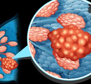Breast cancer with close-up of cells