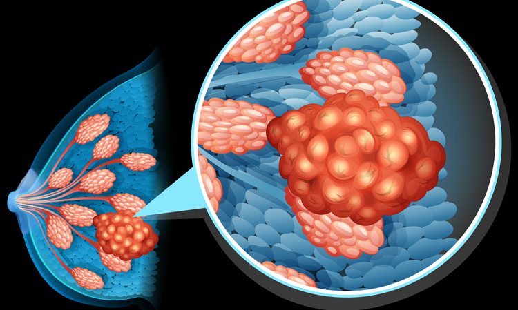 Breast cancer with close-up of cells