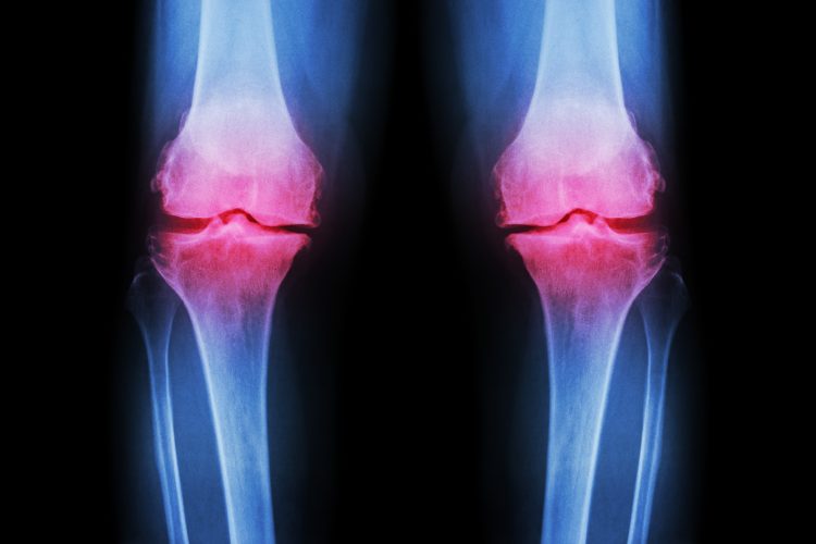 osteoarthritis