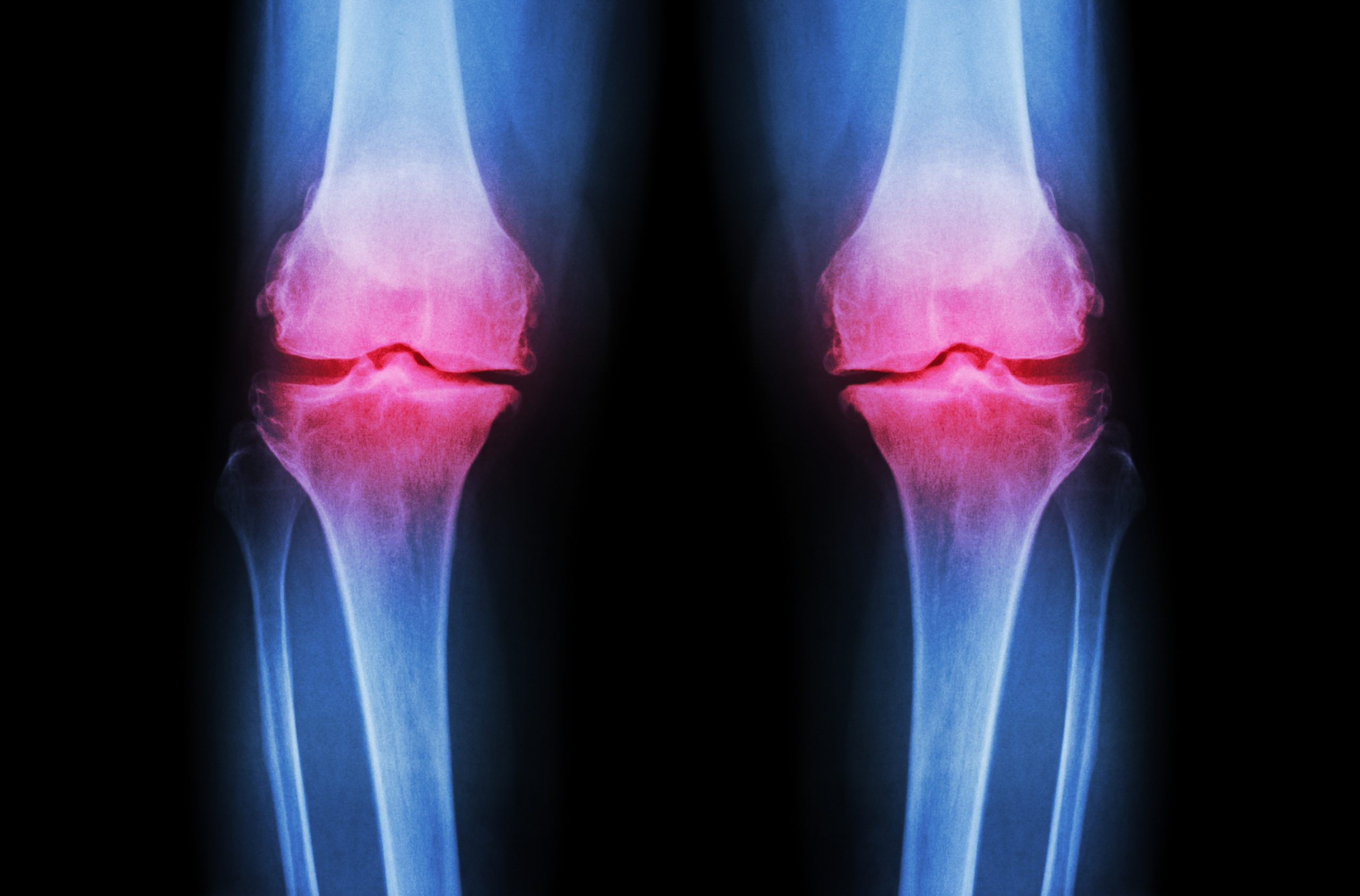 osteoarthritis