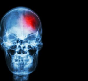 X-ray of skull with red area, indicating stroke