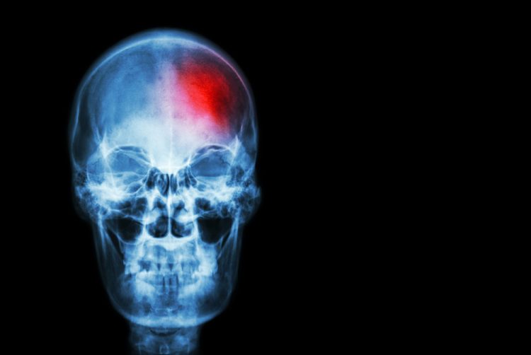 X-ray of skull with red area, indicating stroke