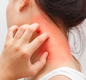 Woman with atopic dermatitis on neck