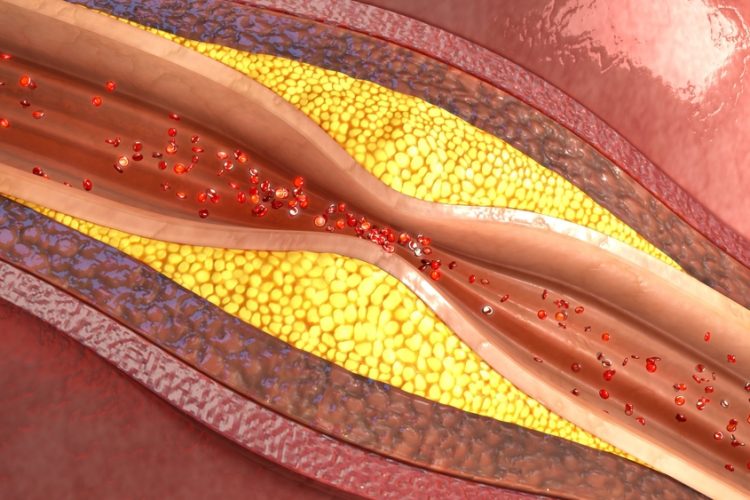 atherosclerosis