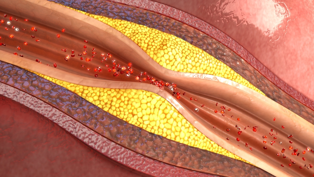 atherosclerosis