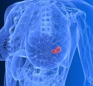 breast cancer