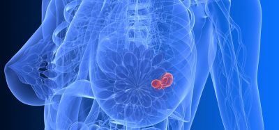 breast cancer