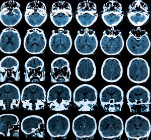 MRI scans of brains - ligands in brain