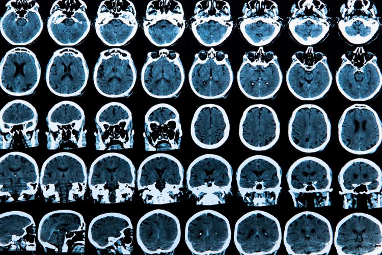 MRI scans of brains - ligands in brain