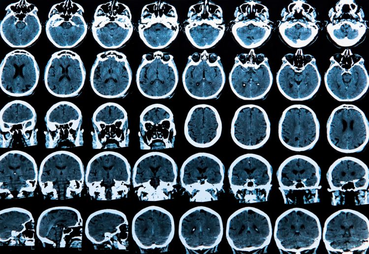 MRI scans of brains - ligands in brain