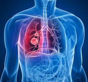 lung