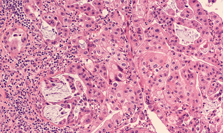 pancreatic cancer cells