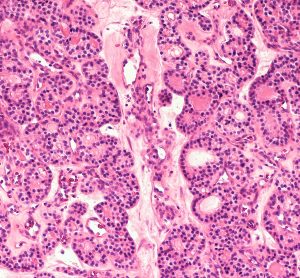 thyroid cancer nodules
