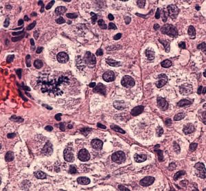 Epigenetic compound inhibits the growth of melanoma cells