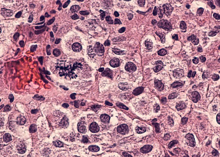 Epigenetic compound inhibits the growth of melanoma cells