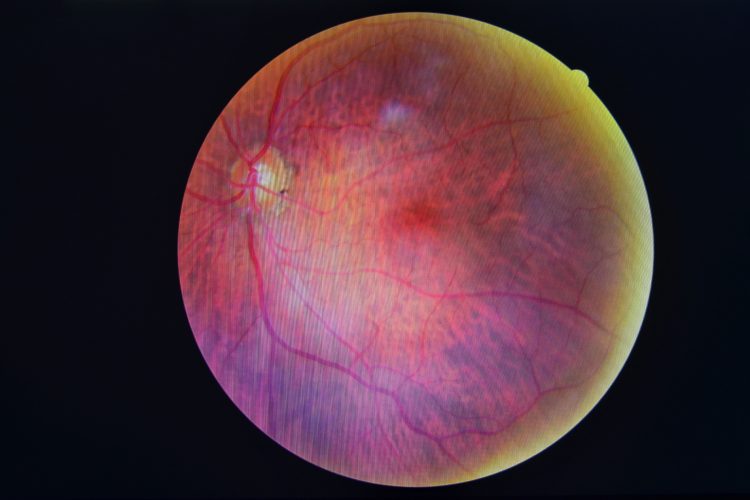 Interventions increase attendance for diabetic retinopathy screening