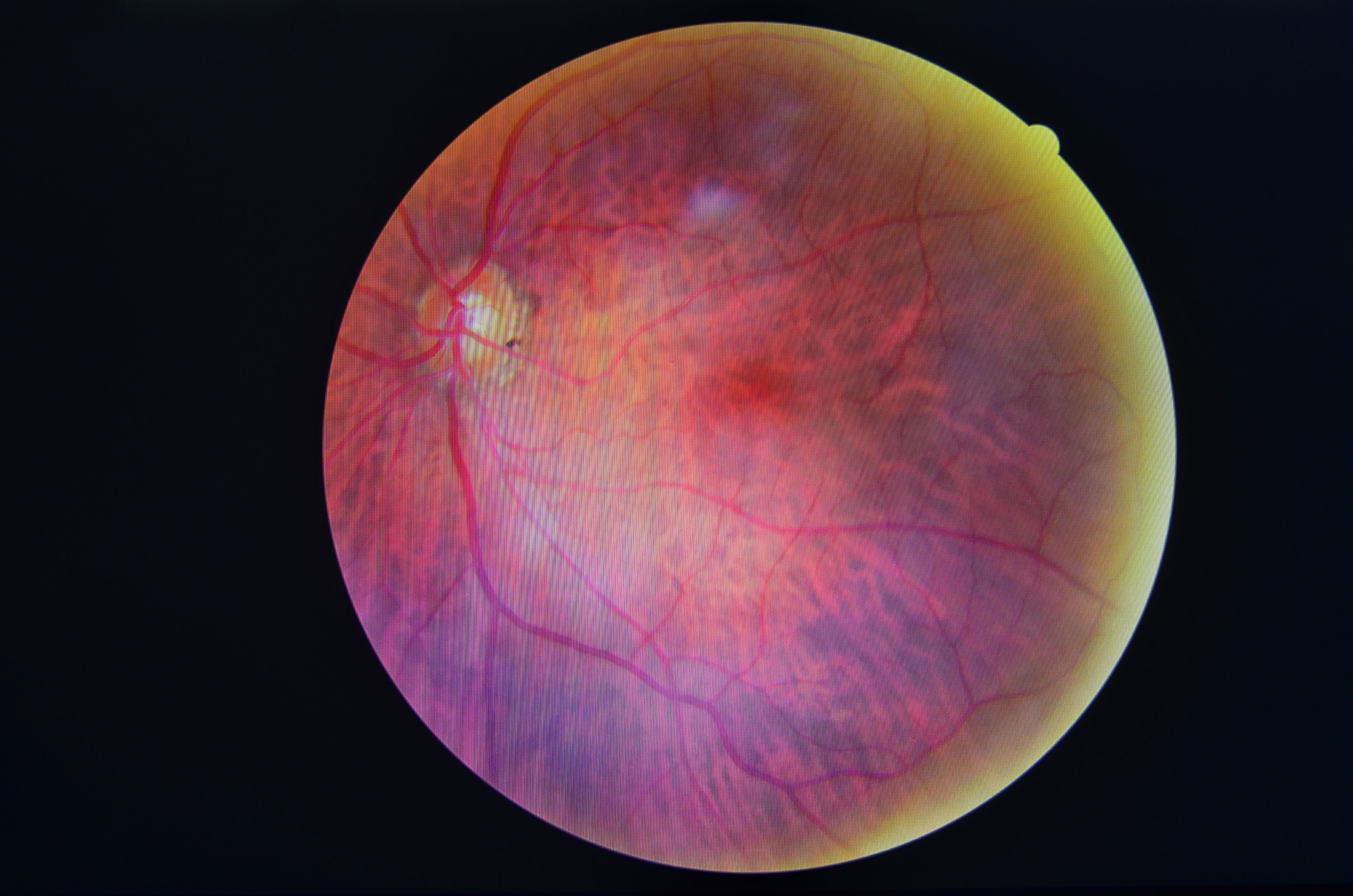 Ангиопатия сосудов сетчатки что это. Почечная ретинопатия сетчатки. Почечная гипертоническая ретинопатия. Диабетическая ретинопатия исход.