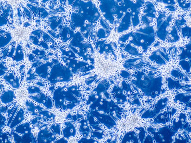 Glioblastoma brain cancer cells under microscope