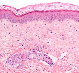 breast cancer