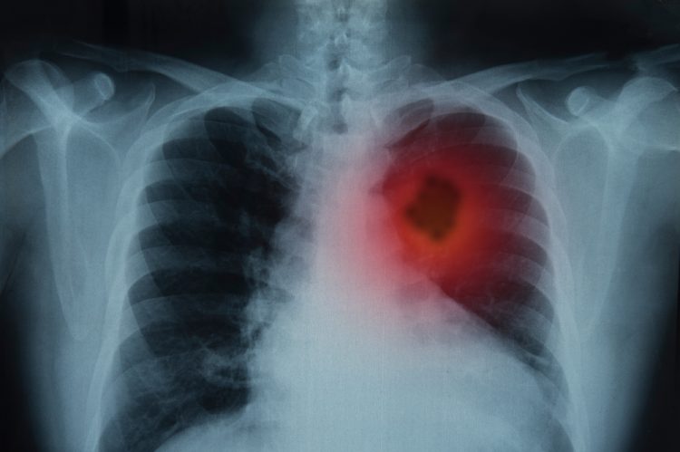 X-ray of lungs with lung cancer tumour