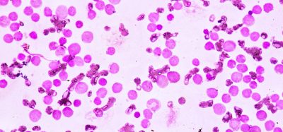 Blood smear under microscopy showing acute myeloid leukaemia (AML)
