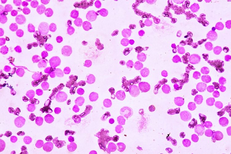 Blood smear under microscopy showing acute myeloid leukaemia (AML)