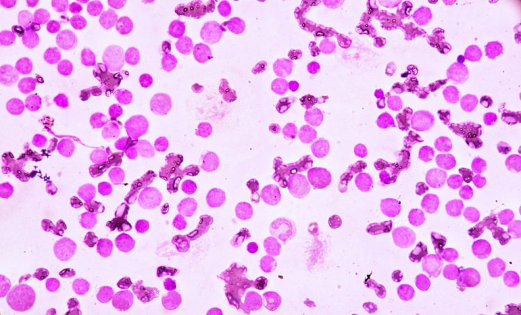 Blood smear under microscopy showing acute myeloid leukaemia (AML)