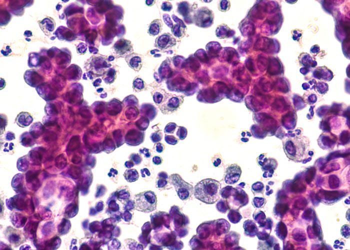 osteosarcoma