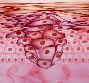 tumours