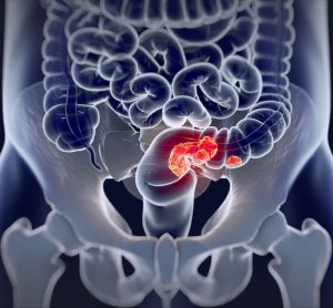 Colorectal cancer