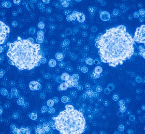 Glioblastoma