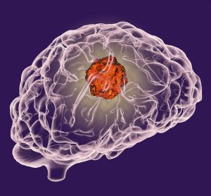 DIPG brain cancer