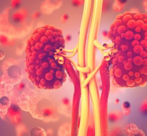 Polycystic kidneys