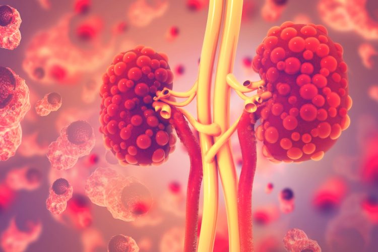 Polycystic kidneys