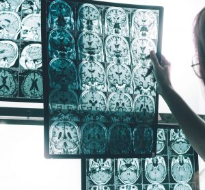 Alzheimer's shown on MRI brain scan