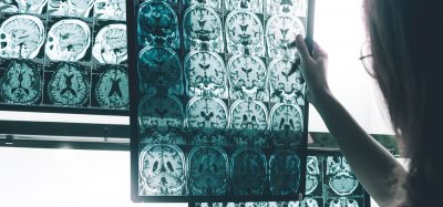 Alzheimer's shown on MRI brain scan