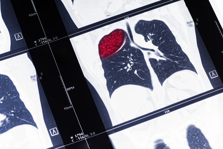 Lung scan showing tumour in red