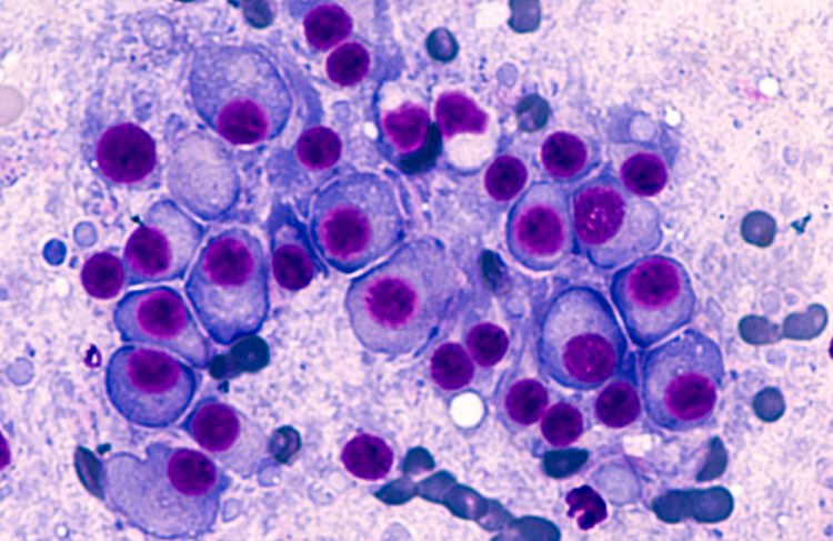 Multiple myeloma