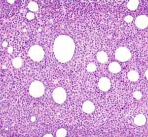 Harnessing the power of genomic sequencing augments diagnosis and treatment of lymphoid cancer