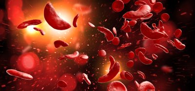 sickle-anaemia