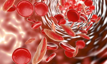 misshapen blood cells misshapen blood cells
