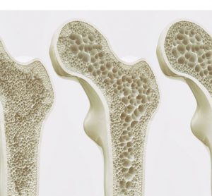 bone deterioration small molecules