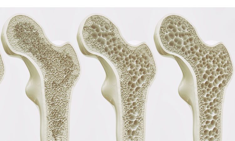 bone deterioration small molecules